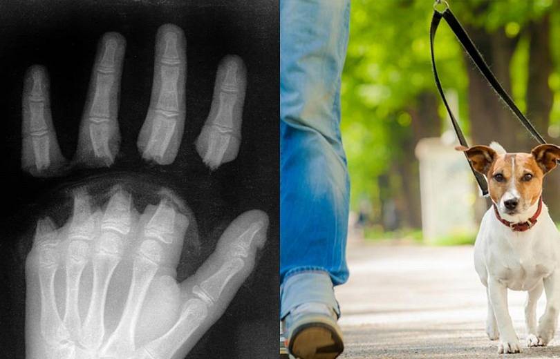 «Սուրբ Աստվածամայր» ԲԿ է ընդունվել 12 տարեկան երեխա՝ ձեռքի չորս մատների ամպուտացմամբ