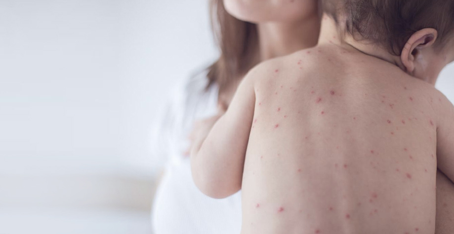 Կարմրուկի լաբորատոր հաստատված դեպքերի թիվը հասել է 200-ի