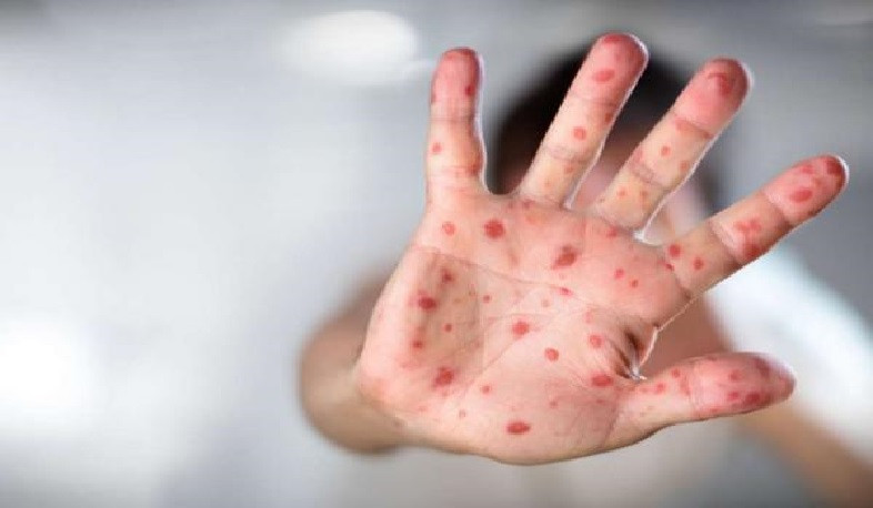 ՀՀ-ում կարմրուկի լաբորատոր հաստատված դեպքերի թիվը հասել է 342-ի