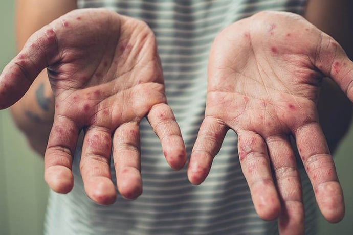 Հայաստանում կարմրուկի 472 դեպք է գրանցվել