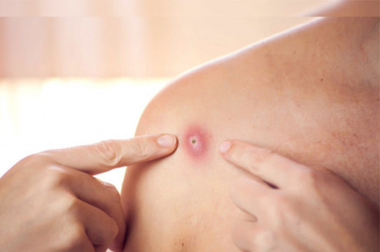 Հայաստանում «Կապիկի ծաղիկ»-ի դեպք չի գրանցվել. ԱՆ